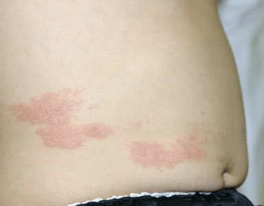 かわいい子供たちの画像 最新のhd子供 汗疹 背中